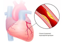 Сужение коронарной артерии сердца