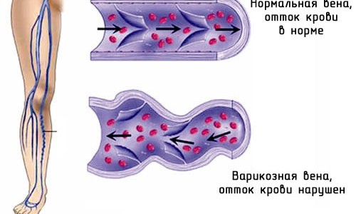 Схема варикоза