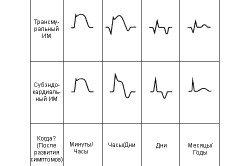 Классификация инфарктов