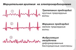 Мерцательная аритмия на электрокардиограмме 