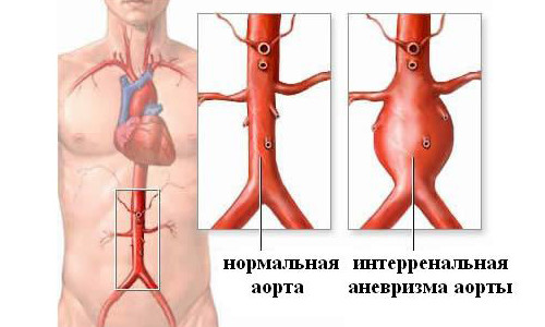 Схема аневризмы брюшной аорты