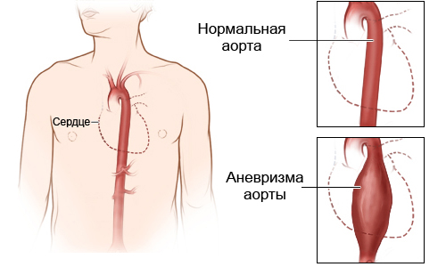 Схема расслоения аорты