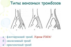 Типы венозных тромбозов