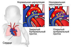 Врожденная болезнь сердца