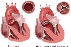 Проблема аортального стеноза