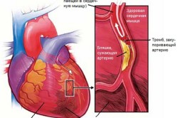 Схема атеросклероза аорты сердца