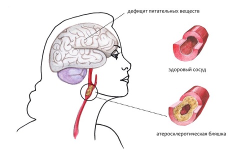 Схема церебрального атеросклероза сосудов головного мозга