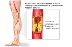 Схема атеросклероза ног