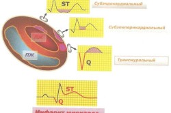 Диаграмма формирования основных ЭКГ-признаков инфаркта миокарда