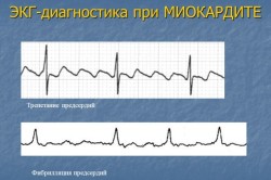 Электрокардиограмма при миокардите