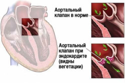 Схема ревматического эндокардита