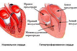Гипертрофированное и нормальное сердце