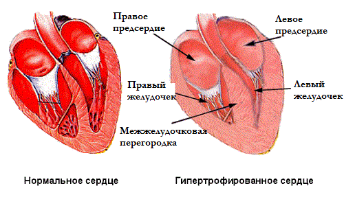 Схема гипертрофированного сердца