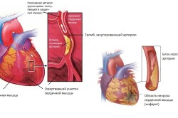 Схема инфаркта миокарда
