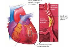 Инфаркт - причина кардиогенного шока