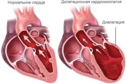 Схема кардиосклероза