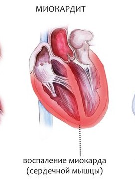 Миокардит сердца фото