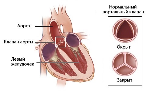 Схема аортального порока сердца