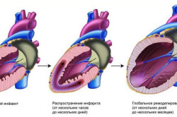 Этапы развития инфаркта