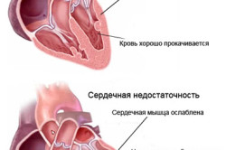 Схема декомпенсированной сердечной недостаточности