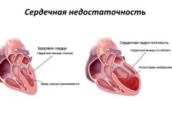 Схема сердца при сердечной недостаточности