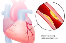 Схема стеноза артерии