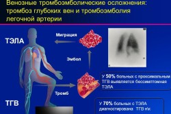Схема образования тромбоза легочной артерии