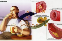 Схема развития атеросклероза