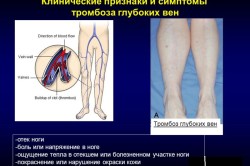 Клинические признаки и симптомы тромбоза глубоких вен 