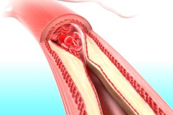 Сужение кровеносных сосудов - причина повышения артериального давления