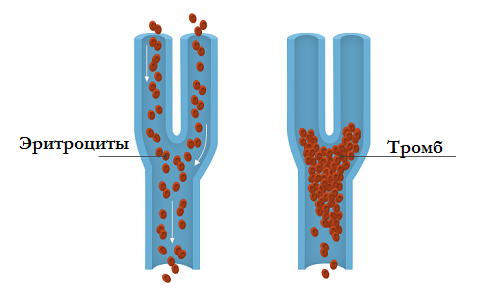 Схема тромбоза