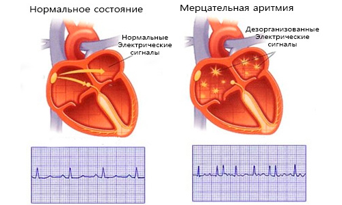 Схема мерцательной аритмии