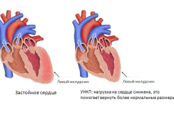 Сердечная недостататочность - следствие гипертонии 3 степени