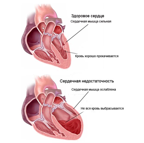 Застой крови у мужчин. Левожелудочковая сердечная недостаточность. Левожелудочковая сердечная недостаточность причины. Острая сердечная недостаточность тромбоэмболия. Сердечная недостаточность давление.